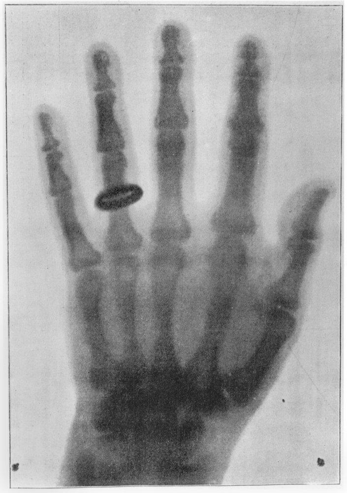 X-ray of the Left Hand of Anna Bertha Ludwig, Röntgen's Wife