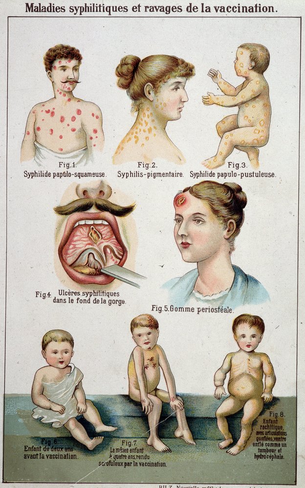 Plate illustrating the different forms of syphilitic diseases and the dangers of vaccination - in Bilz natural medicine, late 19th century. by Unknown artist