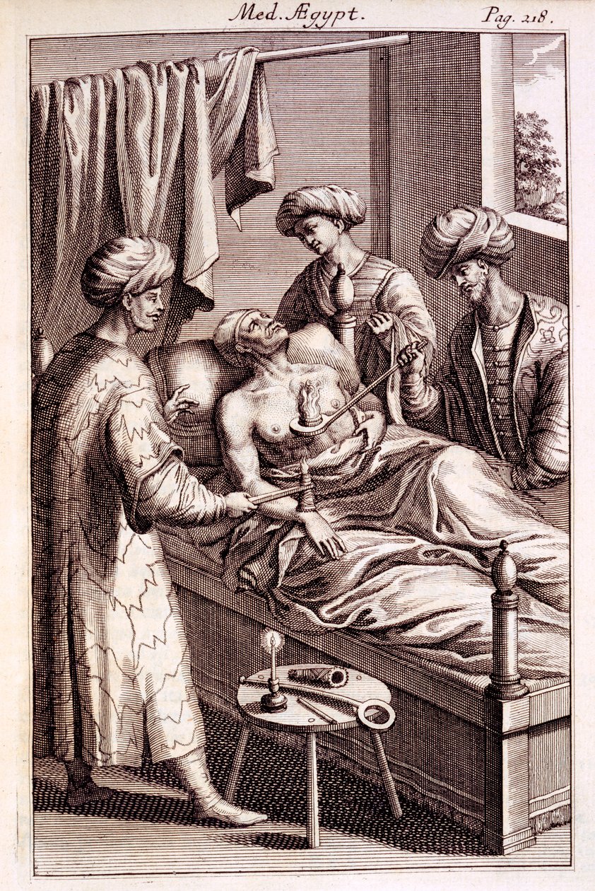 Illustration of moxibustion from Medicina Aegyptorum by Prospero Alpinus, 1745 by American School