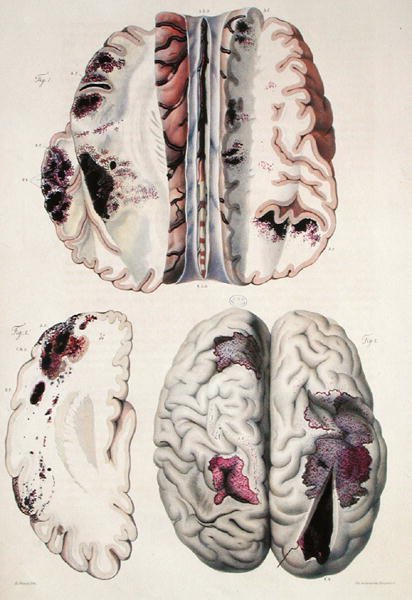 Capillary apoplexy, from 