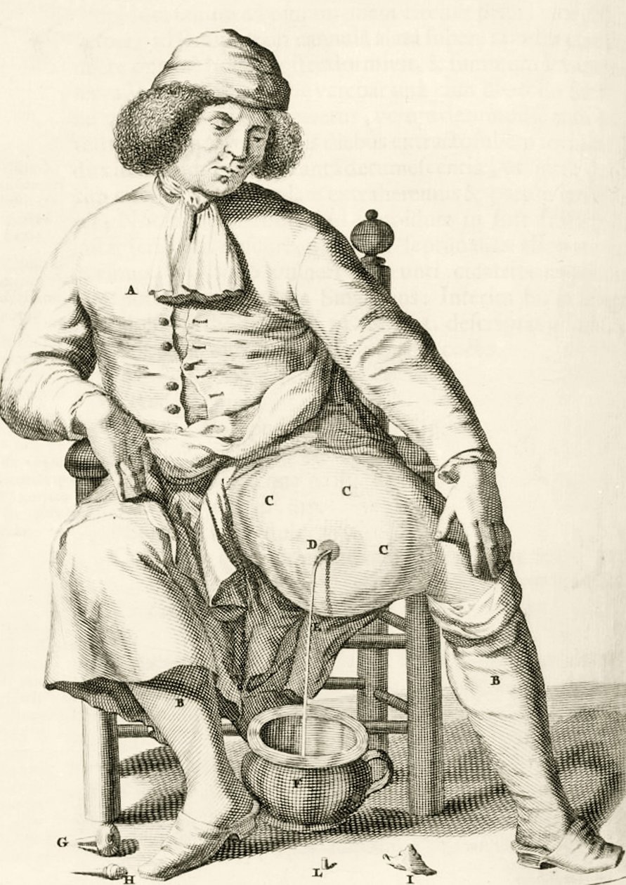 Draining fluid from an abscess, from Exercitationes Practicae circa Medendi Methodum by Frederik Dekkers, 1694 by Dutch School