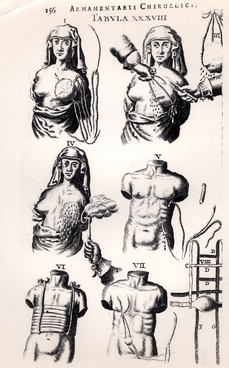 Operating on breast cancer, from Armamentarii Chirurgici by Johannes Schultes published in Amsterdam, 1672 by Dutch School