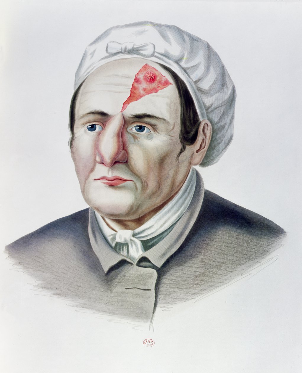 After a Skin Graft Operation, from Selecta Praxis Medico-Chirurgica by Alexander Auvert, Paris, 1856 by French School