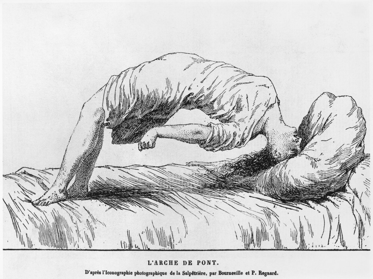 Hysteria and Somnambulism, from Les Maladies Epidemiques de l