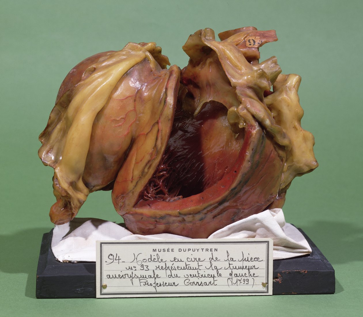 Model of a tumour of the left ventricle, 1799 by French School