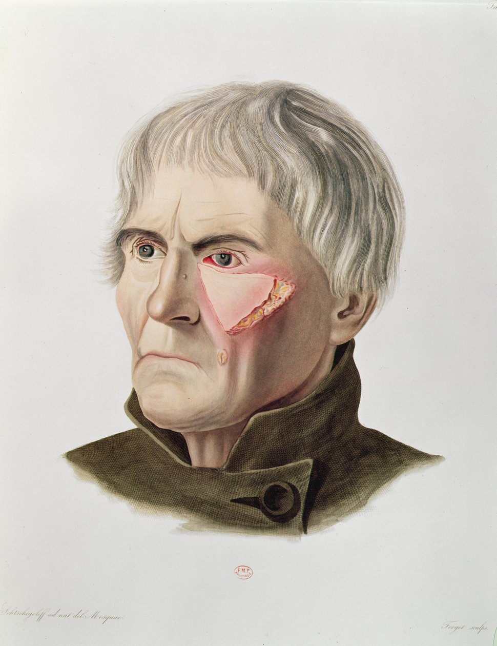 Skin Graft Operation, from Selecta Praxis Medico-Chirurgica by Alexander Auvert by French School