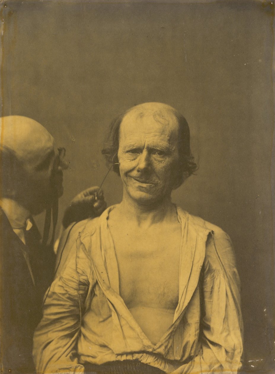 A Relaxed Face (left); False Joy or Laughter (right) by Guillaume Benjamin Amant Duchenne