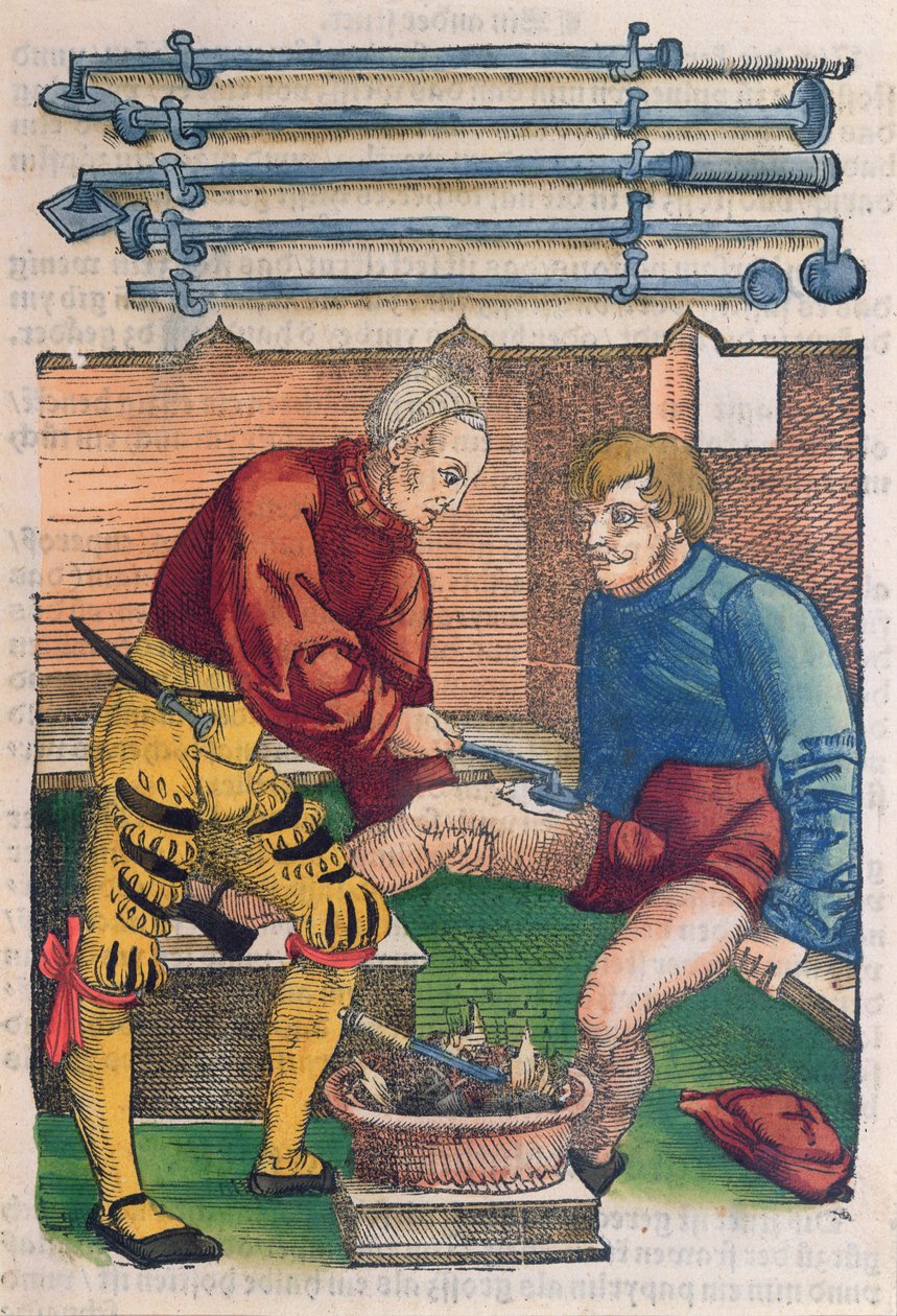 Cauterisation, illustration from 