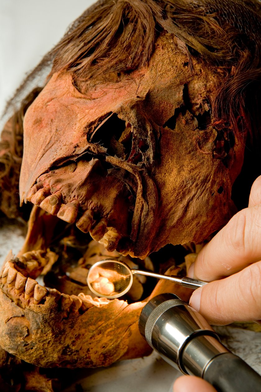 Dr. John Varano examines the teeth of the mummy by Ira Block