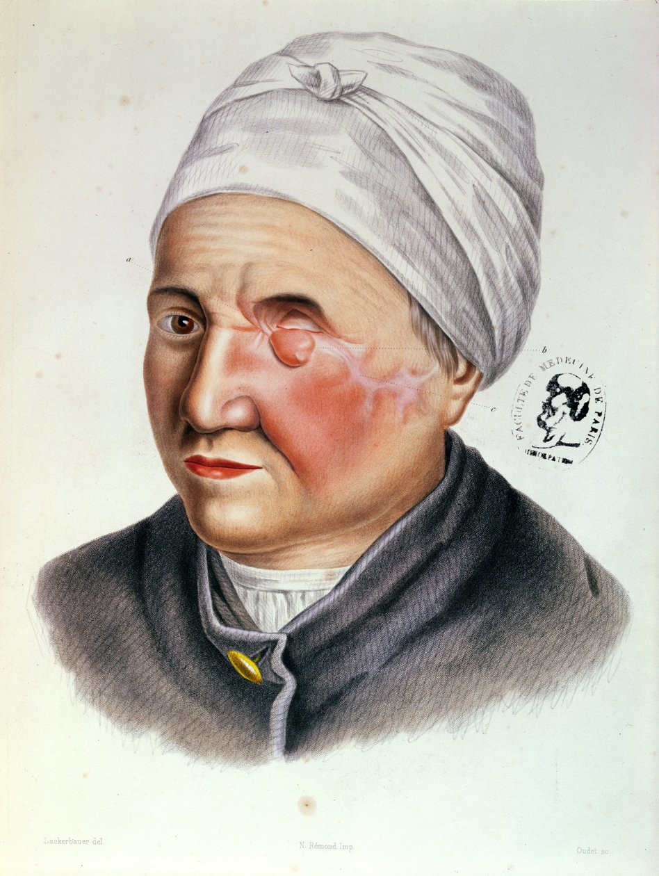 Illustration from Traite de Chirurgie Plastique by Antoine Jobert de Lamballe (1799-1867) Paris, 1849 by Lackerbauer