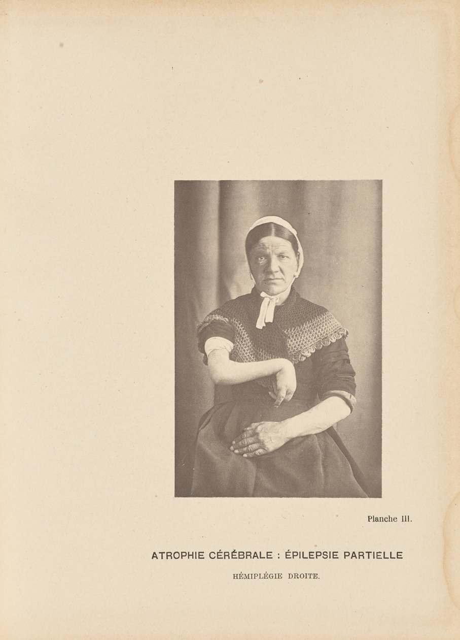 Cerebral Atrophy: Partial Epilepsy Right Hemiplegia by Paul Marie Léon Regnard