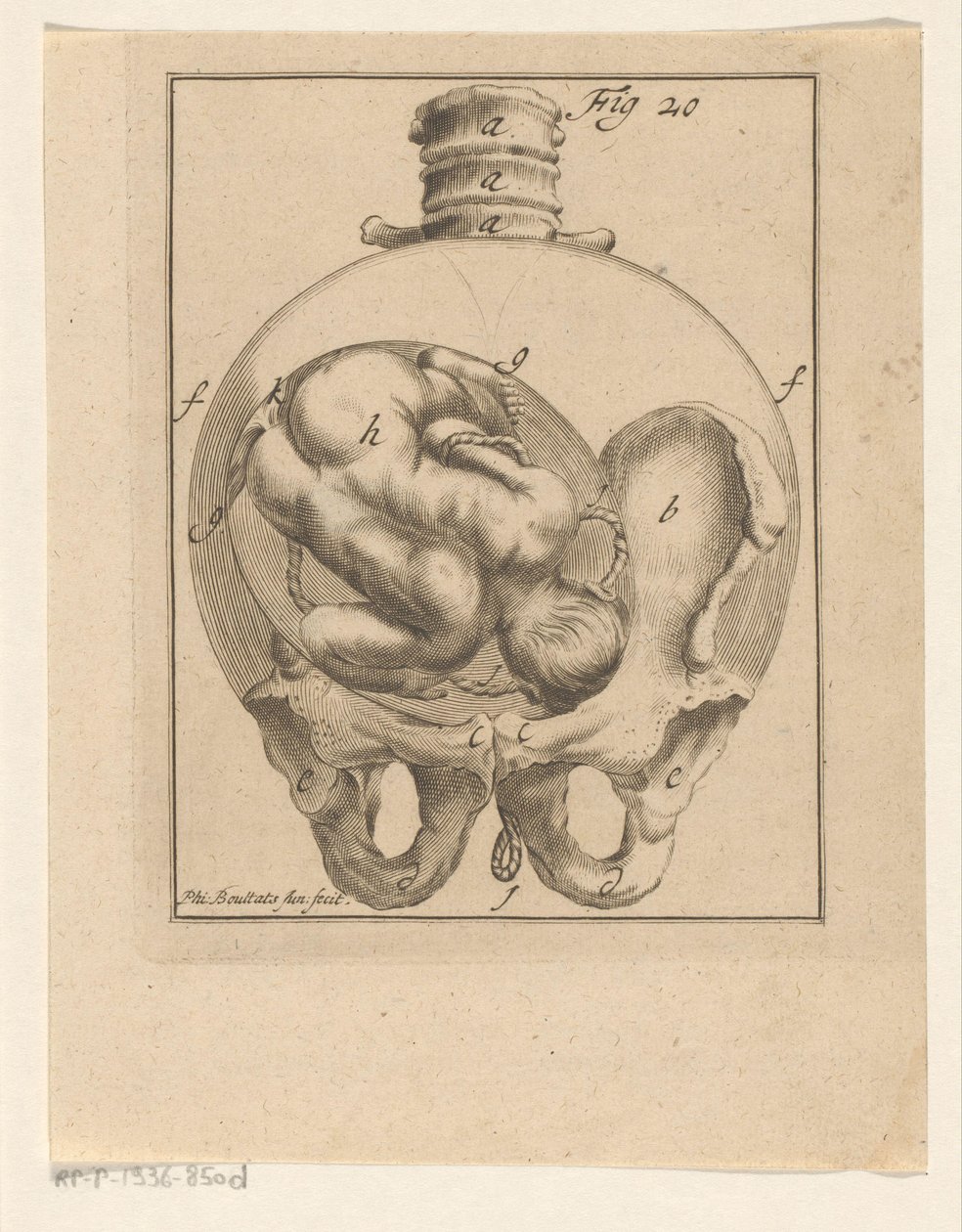Fetus in Womb (Medical Prints on Pregnancy and Birth) by Philibert Bouttats (II)