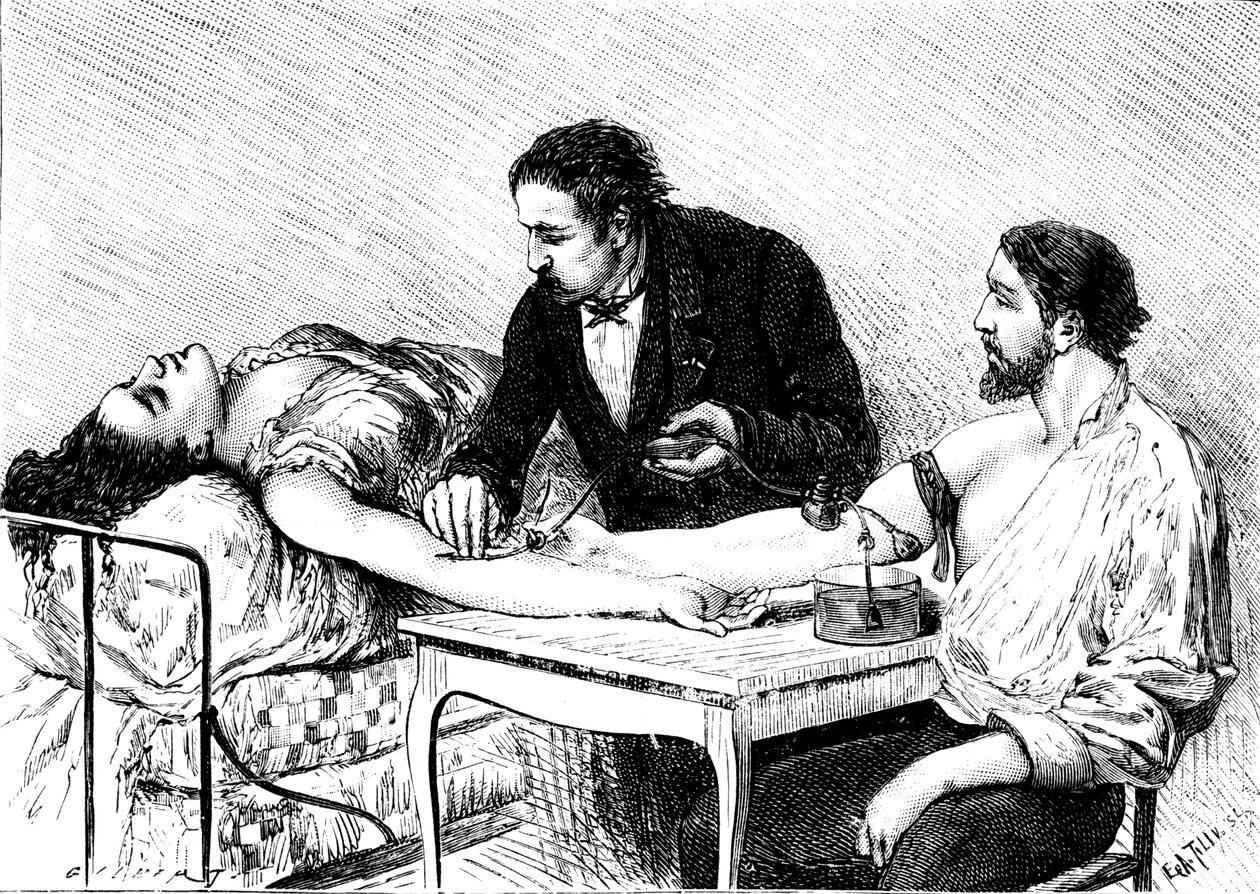 Dr Roussell of Geneva giving a woman a direct blood transfusion from a volunteer, 1882 by Unbekannt