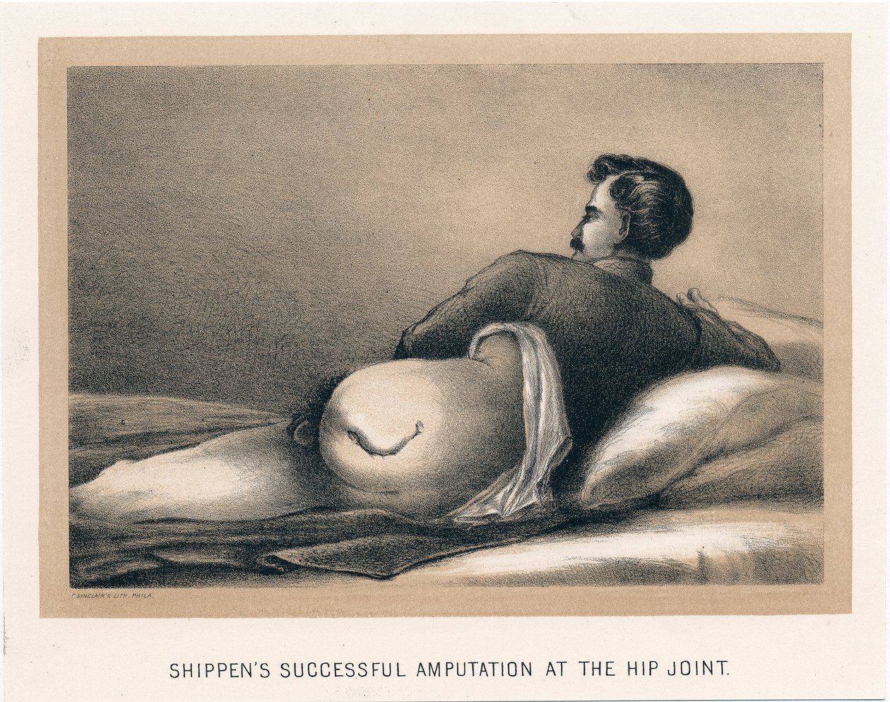 Shippens Successful Amputation at the Hip Joint, American Civil War, 1865 by Unbekannt
