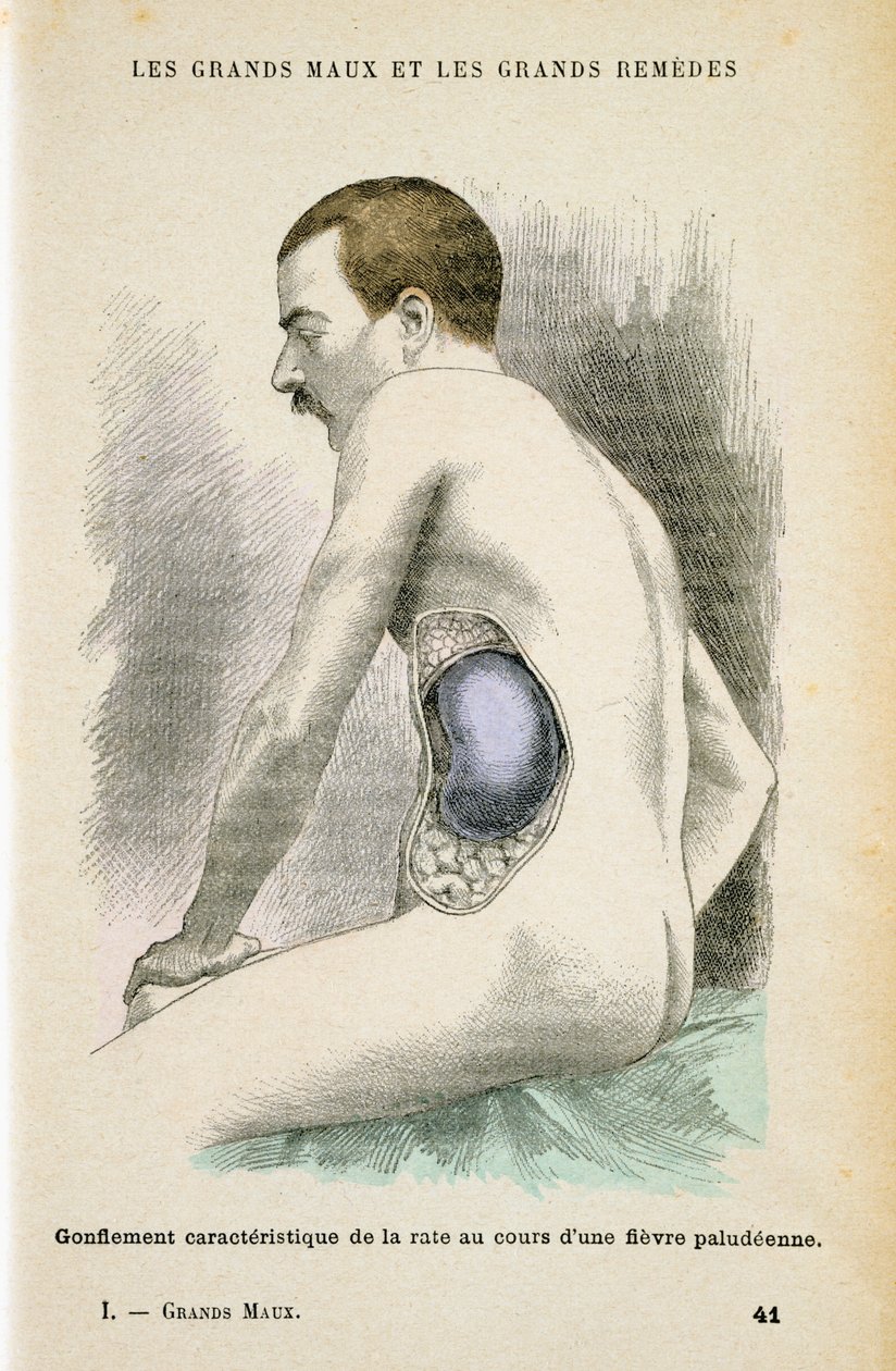 Typical Enlarged Spleen of a Malaria Patient by Unbekannt