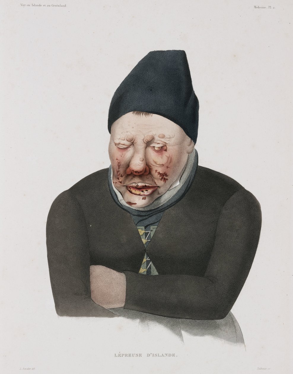 Diseases, Leprosy by Unbekannt