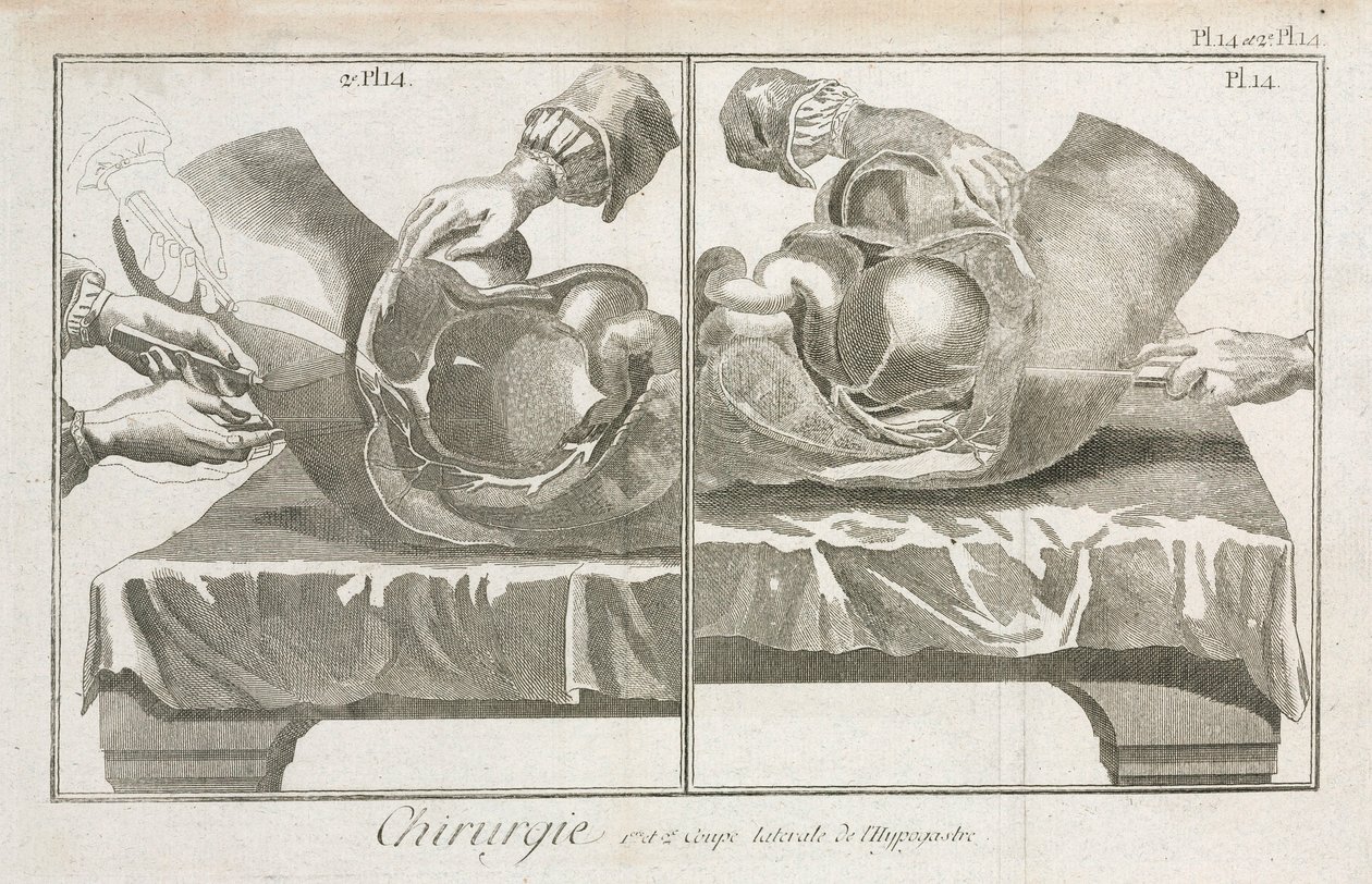 Equipment, Early-Modern Abdominal surgery by Unbekannt