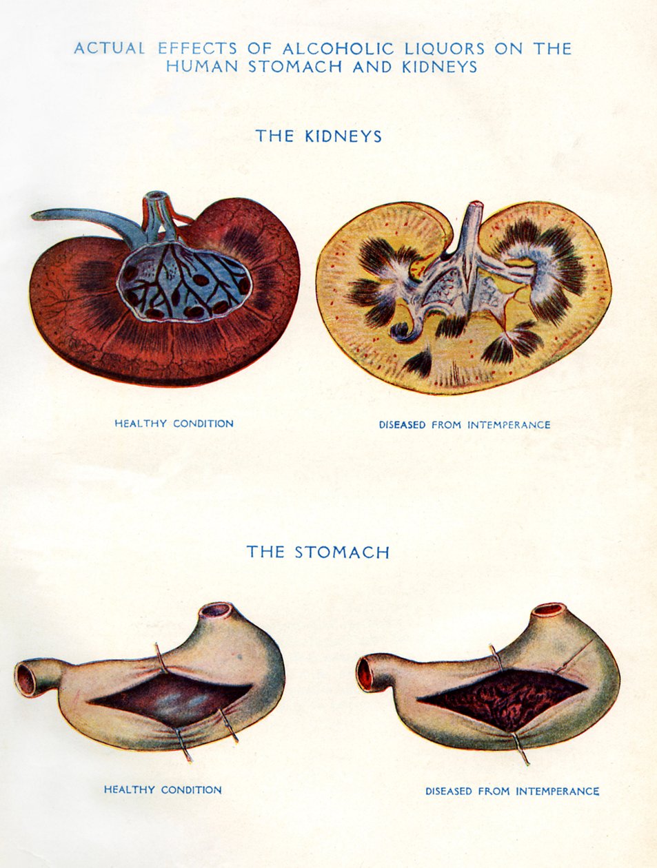 Kidneys and stomach affected by alcohol by Unbekannt
