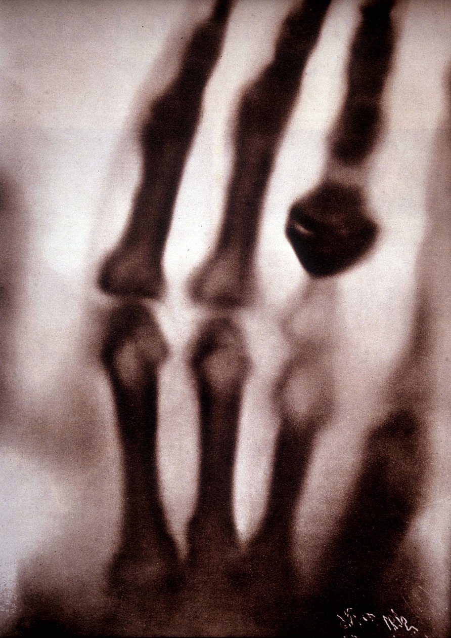 Roentgen rays or X-rays First photograph: the hand of Roentgen's wife ...