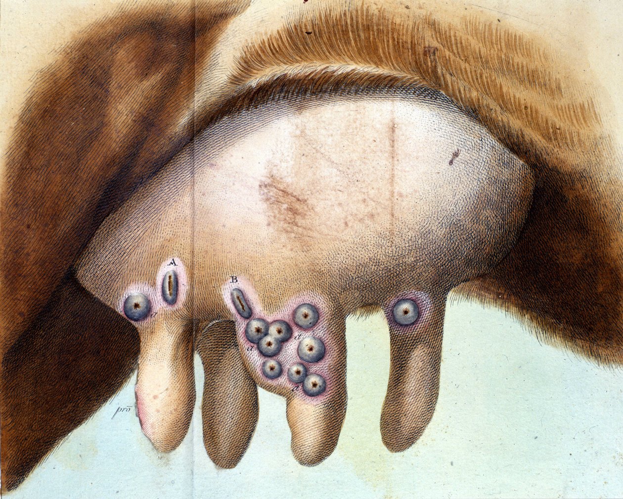 Smallpox 350 Vaccine Shot 1950s Stock Photos, High Res Pictures, And