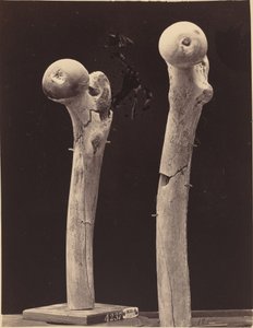 Specimens of Gunshot Fractures of the Femur by American 19th Century