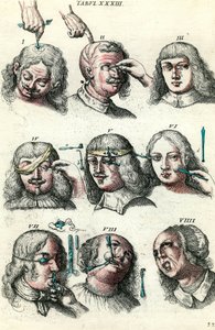 Surgery in the 18th century: Trepanation and operation of the eye and face. Engraving in 