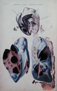 Apoplexy of the heart and of the lungs, illustration plate from Anatomie pathologique du corps humain by Jean Cruveilhier (1791-1874), published in Paris by Antoine Chazal