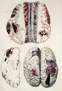 Capillary apoplexy, from 