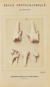 Multiple and Symmetrical Exostoses, Femur, Tibia by Arthur de Montmeja