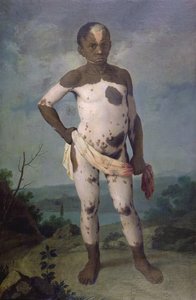 Child with Vitiligo, 1786
