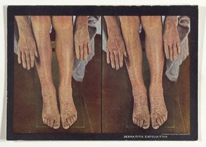 Exfoliative Dermatitis