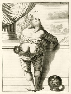 An example of cupping, from Exercitationes Practicae circa Medendi Methodum by Frederik Dekkers, 1694