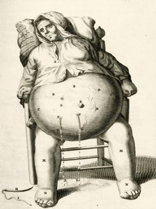 Draining fluids from an abscess, from Exercitationes Practicae circa Medendi Methodum by Frederik Dekkers, 1694