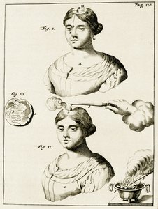 Treating a sufferer of Epilepsy, from Exercitationes Practicae circa Medendi Methodum by Frederik Dekkers, 1694 by Dutch School
