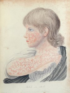 German measles, illustration for a book by Robert Willan, 1808