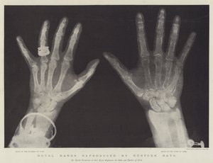 Royal Hands reproduced by Rontgen Rays by English School