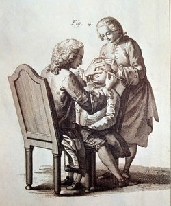 A Doctor operating on a cataract patient (illustration from the Medical Encyclopedia by Denis Diderot and Jean le Rond d