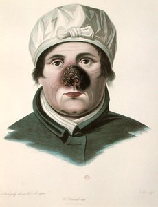 Before a skin graft operation, from 