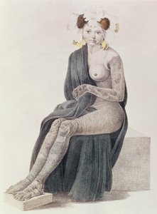 Congenital Ichthyosis, from a Book by G.M. Olbers, 1830 by French School