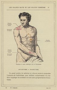 Arthritic Nature Eruptions in a Rheumatic Person by French School