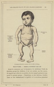 Main Bone Deformations in a Rachitic Child by French School