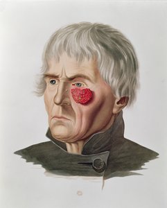 Skin Disease Before an Operation, from Selecta Praxis Medico-Chirurgica by Alexander Auvert