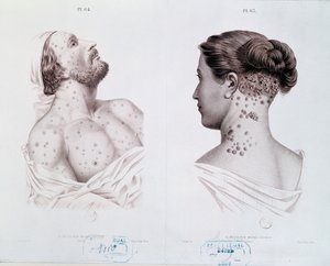 Symptoms of syphilis in men and women, from a medical book
