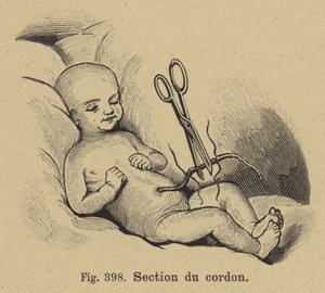 Cutting of a Newborn Baby