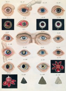 Description of congenital eye anomalies, from Klinische Darstellungen der Krankheiten und Blidungsfehler des Menschlichen Auges, by Friedrich August von Ammon, 1838 by German School