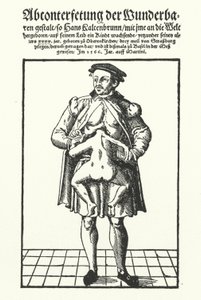 Hans Kaltenbrunn and his undeveloped conjoined twin (engraving) by German School