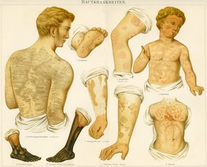 Skin Disorders, c.1890