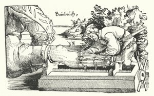 Treating a Fractured Leg by German School
