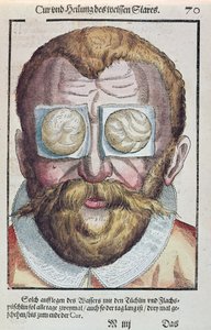 Treating an Eye Condition, from Ophthalmodouleia by Georg Bartisch, published in Dresden in 1583 by German School