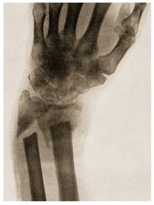 X Ray of a Fractured Wrist by German School